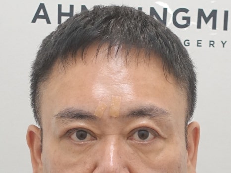 남자 짝짝이 쌍꺼풀 교정 후 32일 경과 [성형외과 전문의 안성민] 관련 이미지 5