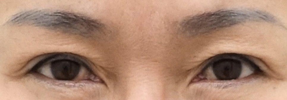 눈썹 거상 수술 효과와 흉터 변화 관련 이미지 1