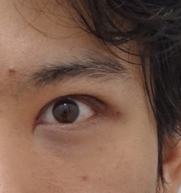 생기있는 남자 눈매완성, 안검하수 눈매교정 관련 이미지 6