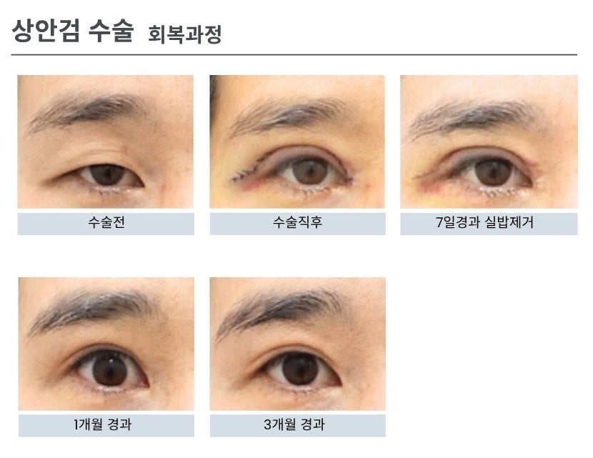 상안검 수술의 모든 것 관련 이미지 1