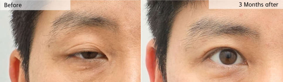 앞트임 수술이란? 내안각 교정술 Epicanthoplasty, 몽고주름 앞트임 성형술 관련 이미지 2