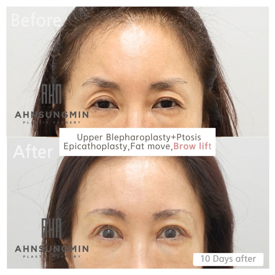 눈썹하거상 수술의 부작용과 눈썹상거상 수술이 필요한이유[성형외과 전문의] 관련 이미지 4