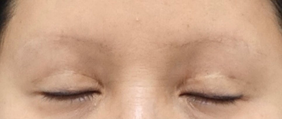 소세지눈 쌍꺼풀 풀기 재수술로 해결 관련 이미지 2