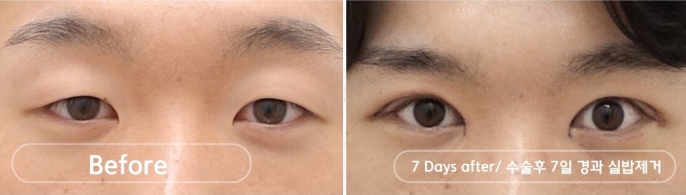 나이대별 상안검 수술, 처진 눈꺼풀을 개선하다 관련 이미지 2