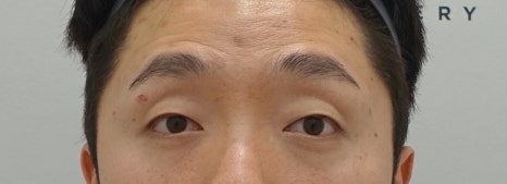 뒷트임 후 눈뜨기가 쉬워요 [성형외과 전문의 안성민] 관련 이미지 9