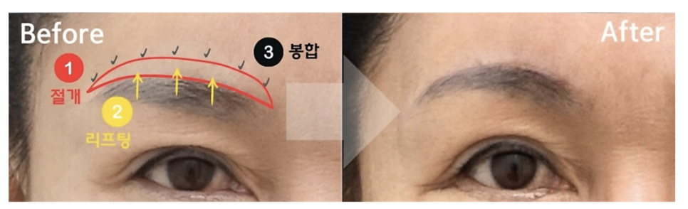 눈꺼풀 처짐을 해결하는 방법, 눈썹 거상 수술이 필요한 경우 관련 이미지 1