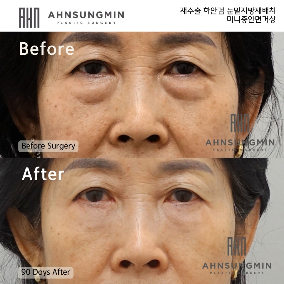 하안검 눈밑지방재배치 재수술이 가능할까요? 관련 이미지 2