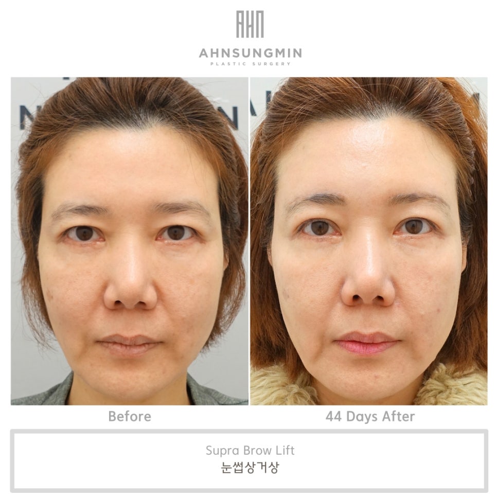 눈썹 거상 수술 흉터와 회복 과정 관련 이미지 5