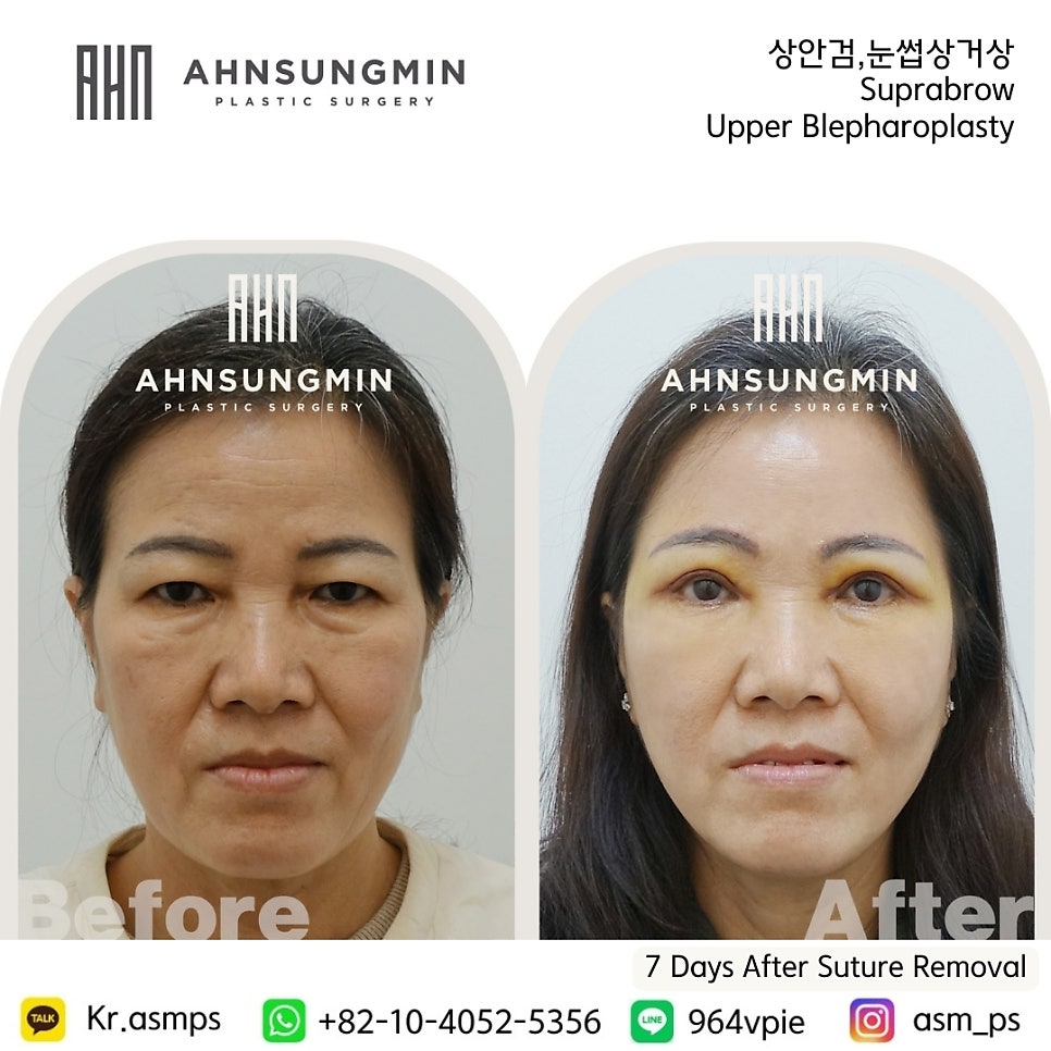 눈썹상거상과 상안검 성형외과 전문의 관련 이미지 2