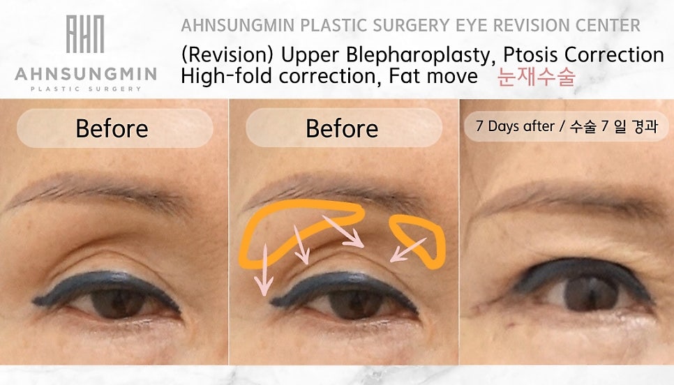 중년 자연스러운 쌍꺼풀 재수술 잘하는 곳, 안성민성형외과 관련 이미지 4