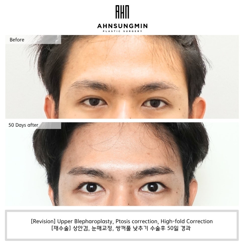 느끼한 남자눈 쌍꺼풀 낮추기 관련 이미지 4