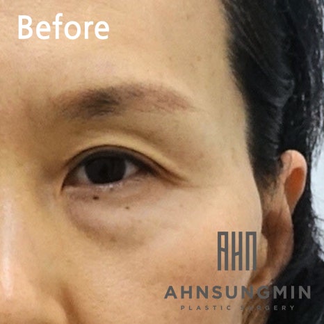 중년의 눈밑지방재배치 수술과 회복 과정 알아보기 관련 이미지 2