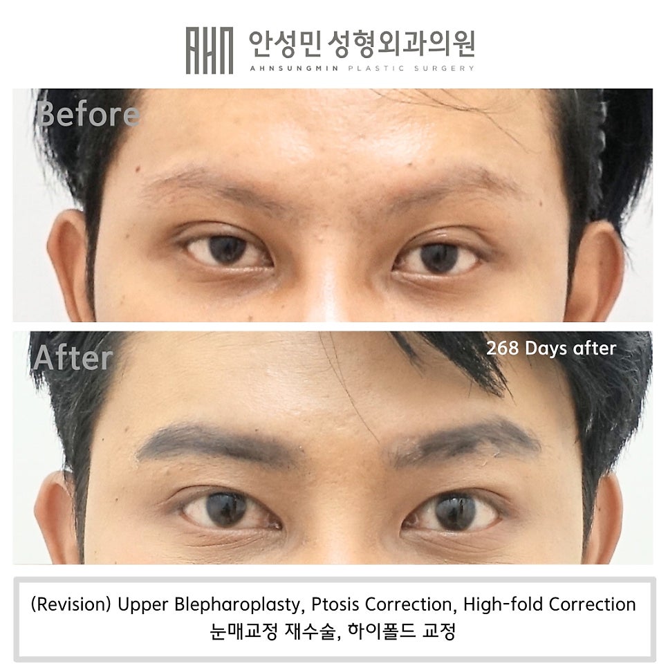 소세지눈 쌍꺼풀 풀기 재수술로 해결 관련 이미지 4