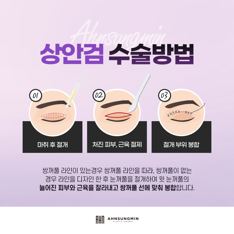 잠실성형외과칼럼 :: 상안검과 하안검 수술 구분. 관련 이미지 4