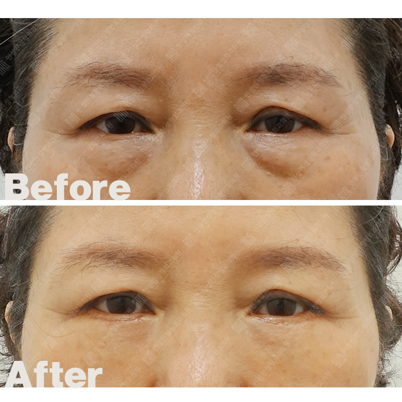 [잠실동성형외과] 하안검지방재배치+미니중안면거상 21일차 경과 총정리! 관련 이미지 2