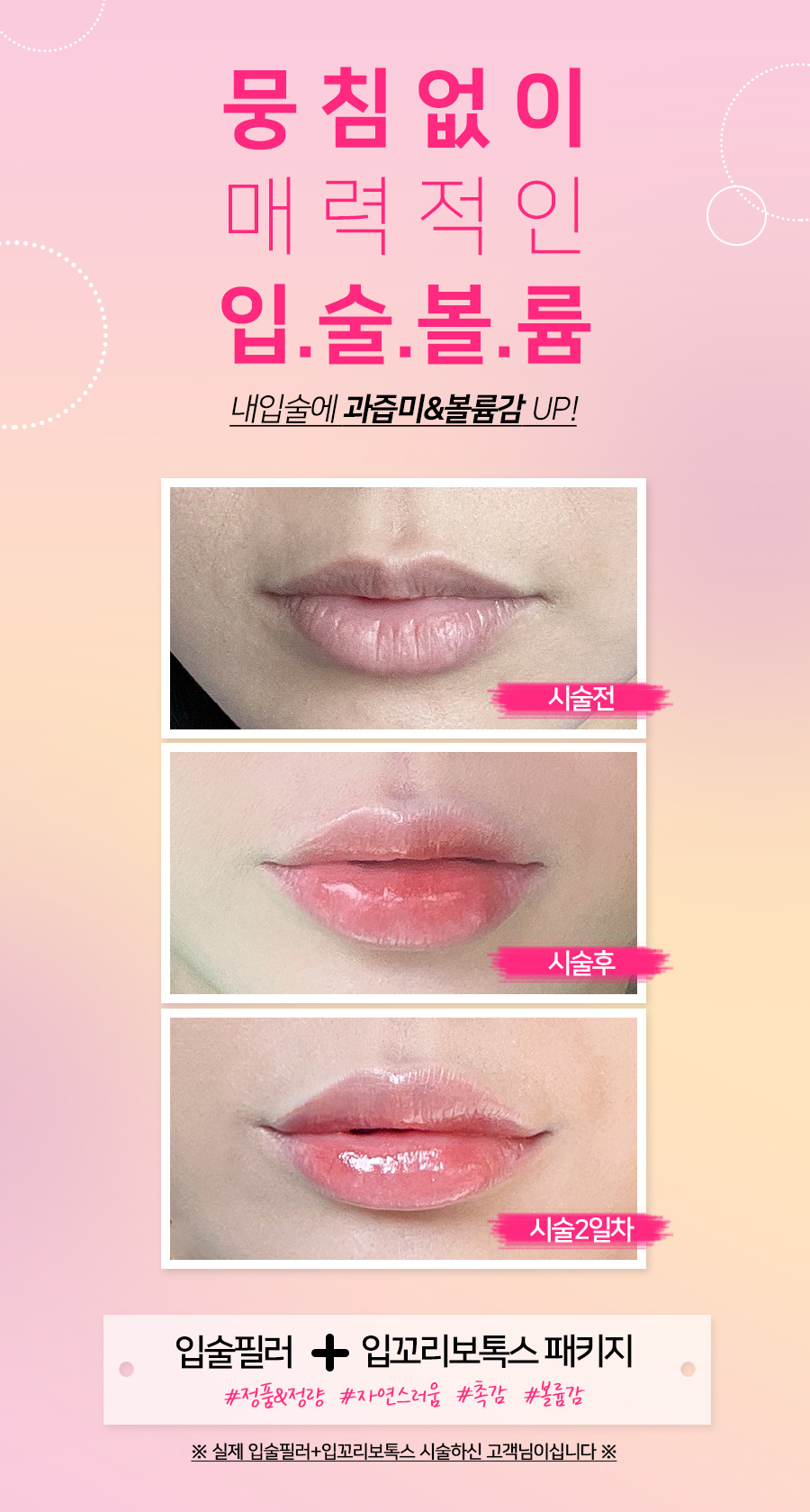 [잠실동성형외과] 절개없이 자연스럽게 예뻐지는 쁘띠성형 / 입술필러 패키지 / 입술필러+입꼬리보톡스 / 잠실성형외과 관련 이미지 2