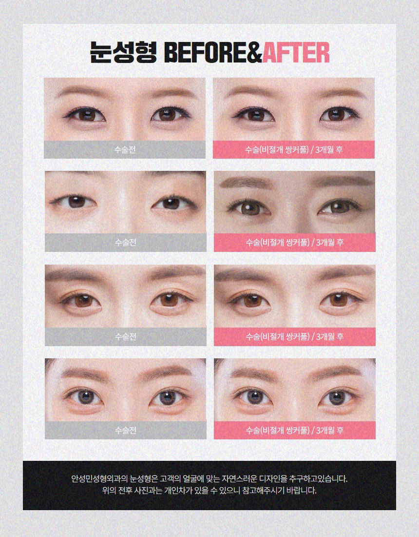 눈꺼풀처짐 노안이미지로 걱정이라면 관련 이미지 6