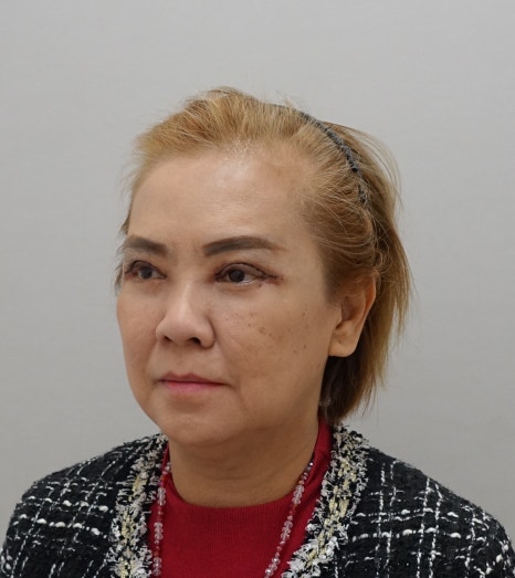 겹주름의 근본적인 원인, 눈 재수술 [성형외과 전문의 안성민] 관련 이미지 5