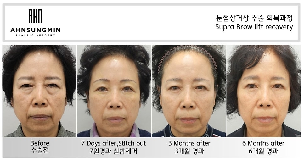 눈꺼풀 처짐을 해결하는 방법, 눈썹 거상 수술이 필요한 경우 관련 이미지 5