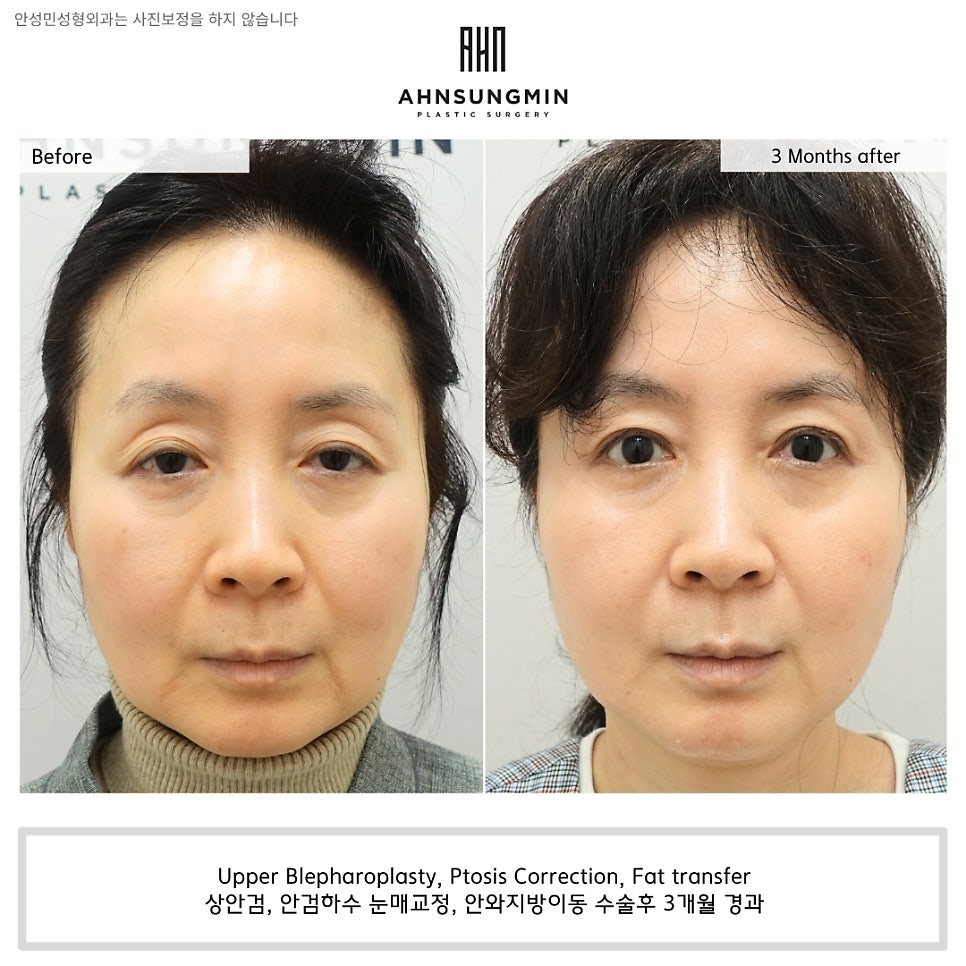 눈꺼풀 꺼짐의 원인과 해결 방법 관련 이미지 4