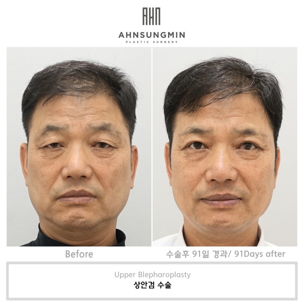중년 남성 상안검 수술 회복기간 얼마나될까? 관련 이미지 3