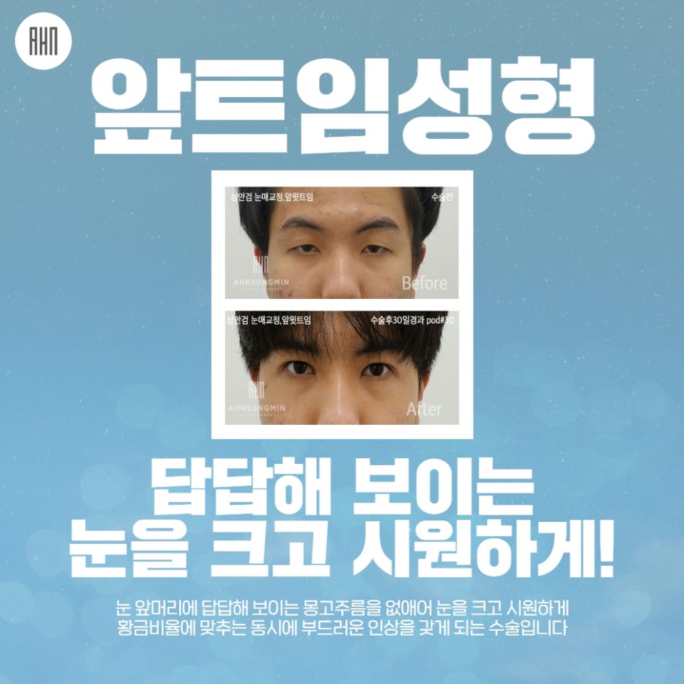 안검하수수술 또렷한 눈매를 원한다면 관련 이미지 10