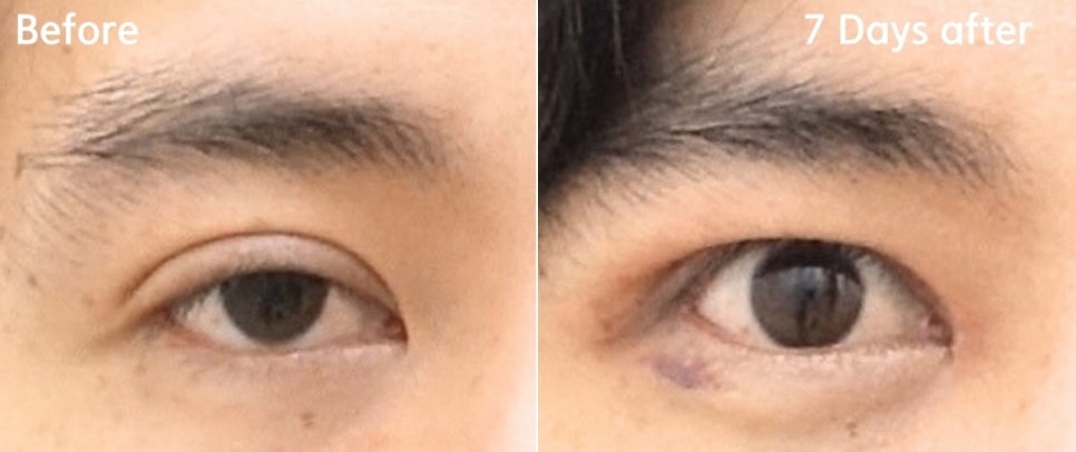 소세지눈 쌍꺼풀 풀기 재수술로 해결 관련 이미지 8