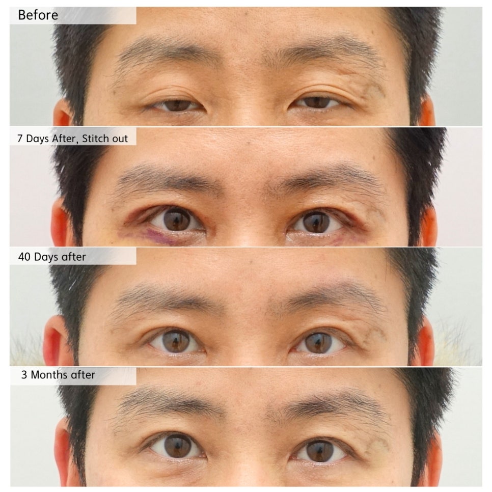 40대 남성 눈매교정 수술, 안검하수 개선과 자연스러운 회복 과정 관련 이미지 2