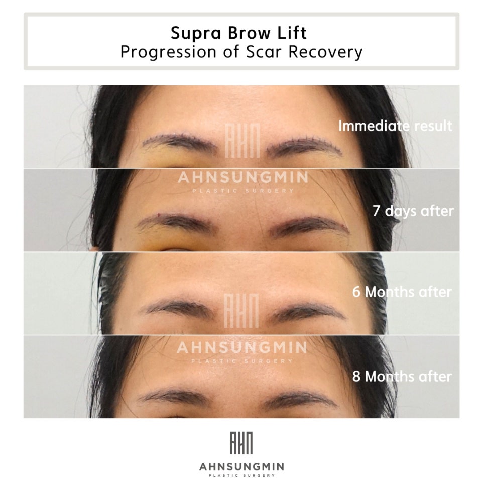 눈썹거상수술,눈썹상거상 수술이 필요한 이유 [성형외과 전문의 안성민 대표원장] 관련 이미지 6