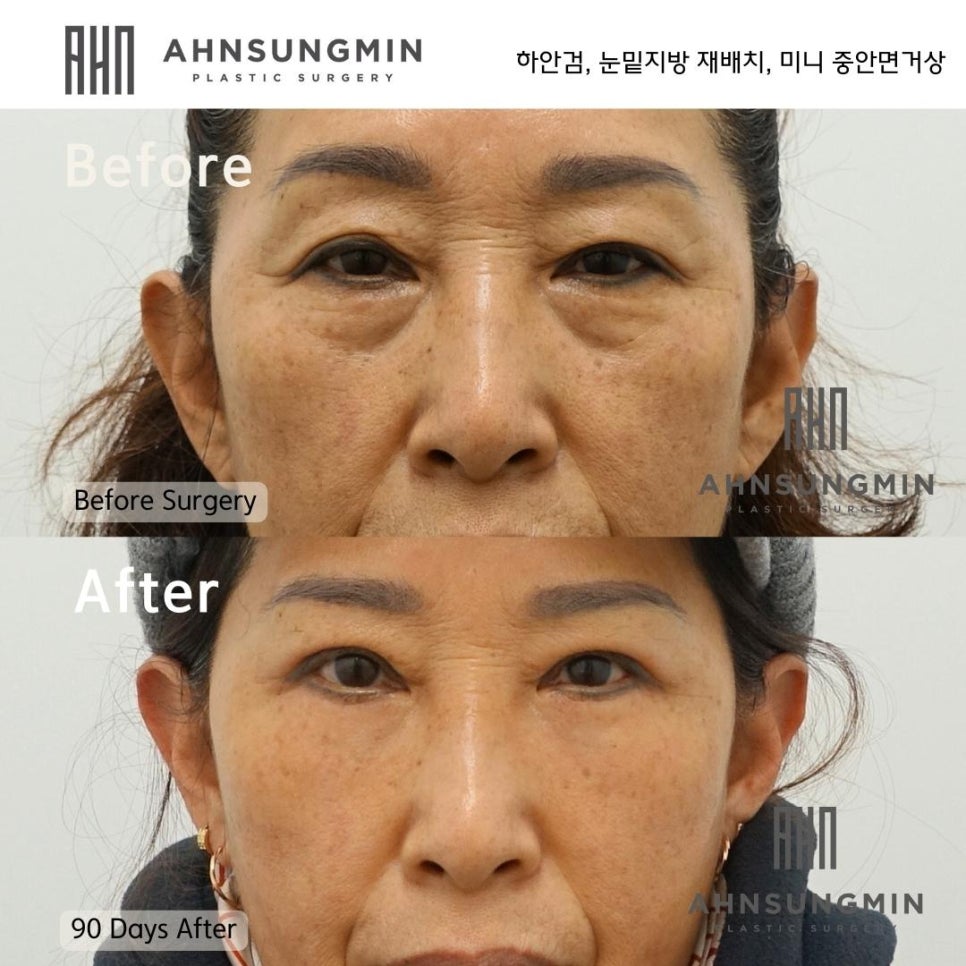 하안검 수술전 체크리스트 혈압조절이 필요한이유 혈압약은 언제부터 복용할까요? 관련 이미지 2