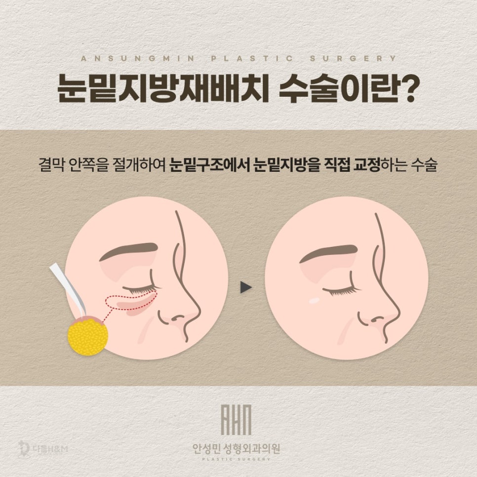눈밑지방재배치 추천대상을 중년눈성형 전문 성형외과에서 알려드립니다. 관련 이미지 2