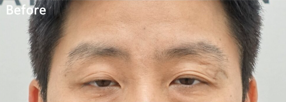 쌍꺼풀이 풀리는 이유와 교정 방법 [성형외과 전문의 안성민] 관련 이미지 3