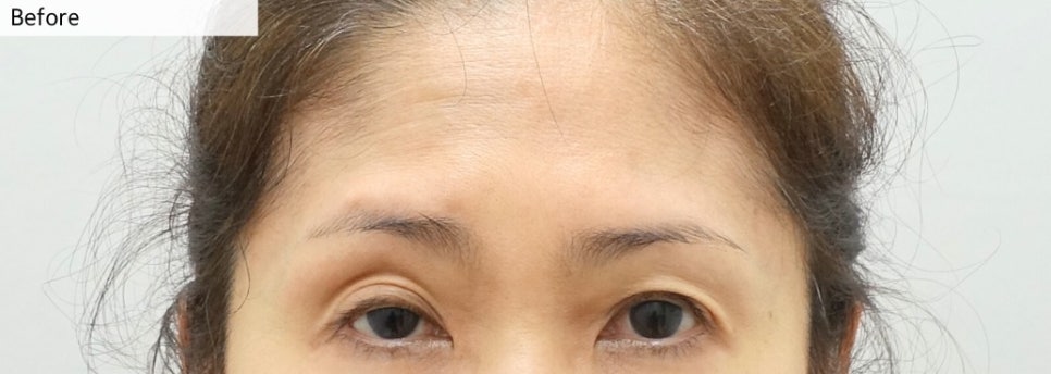 [재수술] 안검하수 짝짝이 교정을 한쪽 눈만 할 수 없는 이유 관련 이미지 1