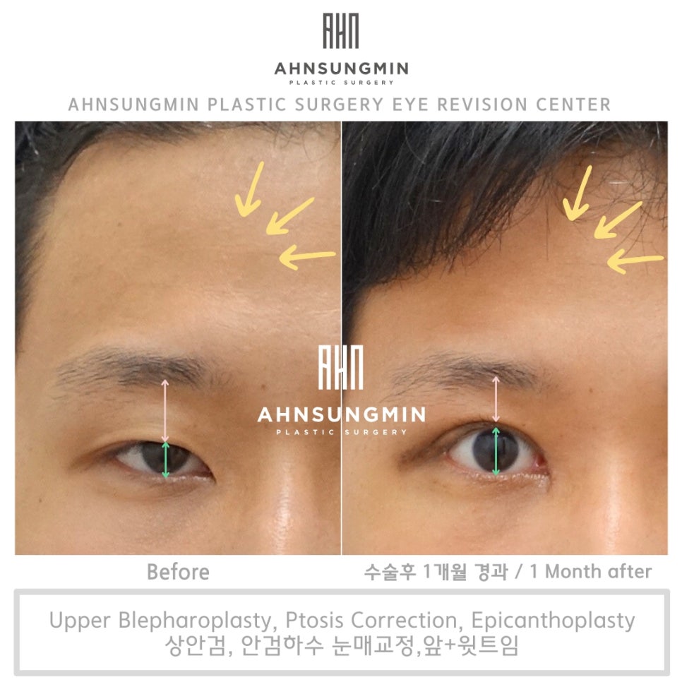 20대 남자 안검하수 수술 전후, 성형외과 전문의 관련 이미지 2