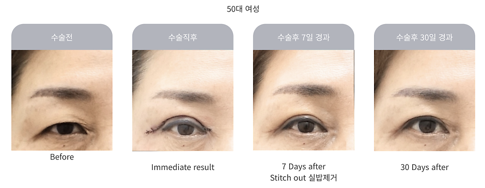 중년 상안검 수술의 특징과 주의사항 관련 이미지 2