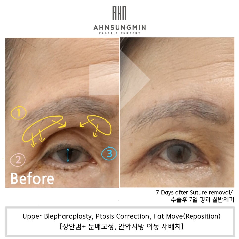 꺼진 눈 나이 들어 보이는 이유, 꺼진 눈 해결 방법 관련 이미지 2