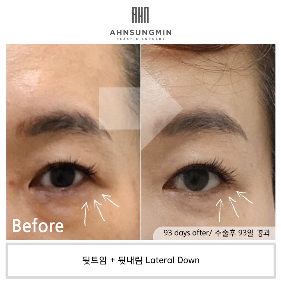 뒷트임 후 눈뜨기가 쉬워요 [성형외과 전문의 안성민] 관련 이미지 2
