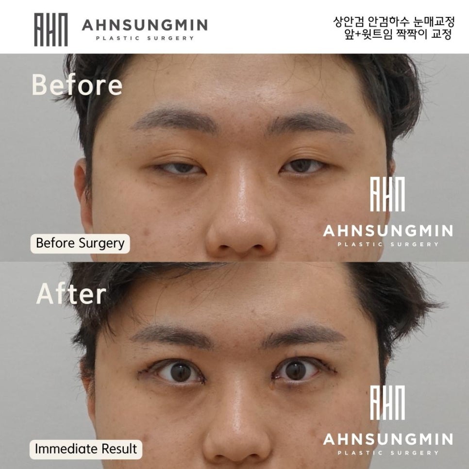 안검하수 짝짝이의 경우 한쪽만 수술해도 되나요? 헤링스 법칙 안성민원장 관련 이미지 2