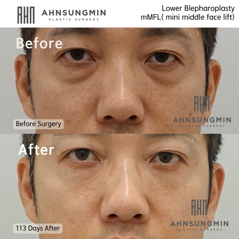 40대 남성의 눈밑지방재배치 관련 이미지 2