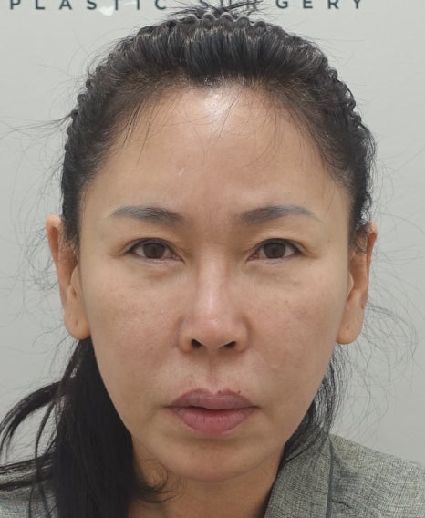 눈썹 거상 수술 후 30일 경과, 1년 경과 관련 이미지 4