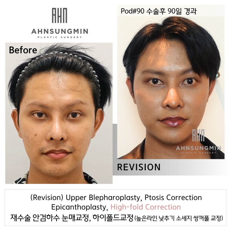 느끼한 남자 눈 무쌍이 되고 싶어요. 두꺼운 쌍꺼풀 낮추기 관련 이미지 4