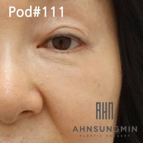 중년 눈 밑 지방재배치 애굣살(애교살) 보존 이유 관련 이미지 5