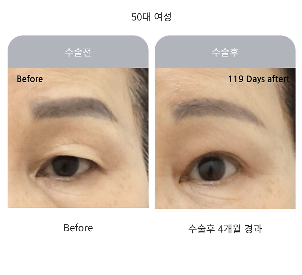 중년 상안검 수술의 특징과 주의사항 관련 이미지 3