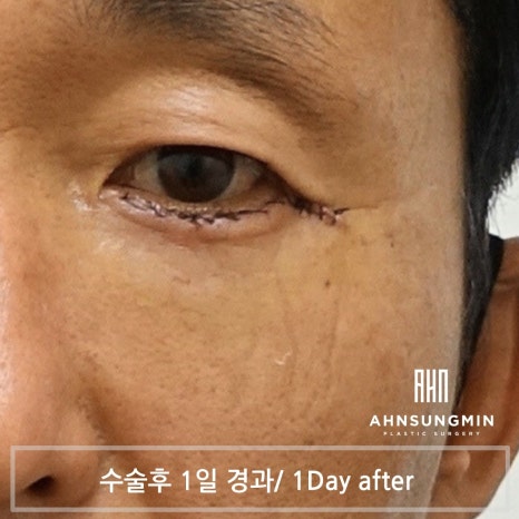 중년 남자 눈 밑 수술 후회 없이 안전하게 잘하려면 [성형외과 전문의 안성민] 관련 이미지 4
