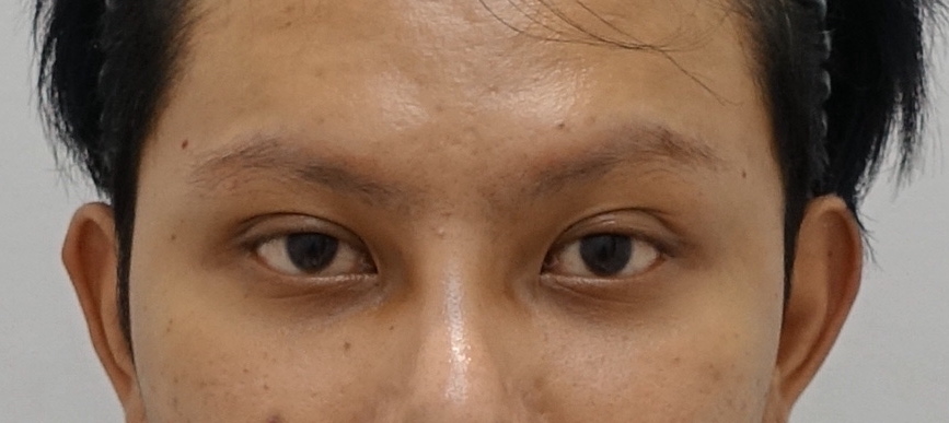 남자 쌍꺼풀 재수술 눈매교정, 짝짝이 교정 잘하는 곳 안성민성형외과 관련 이미지 3