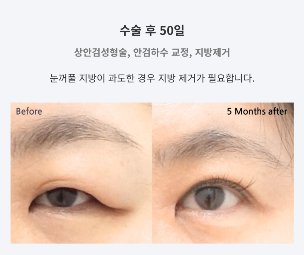 눈꺼풀이 무거울 때, 눈두덩이 지방제거 관련 이미지 1