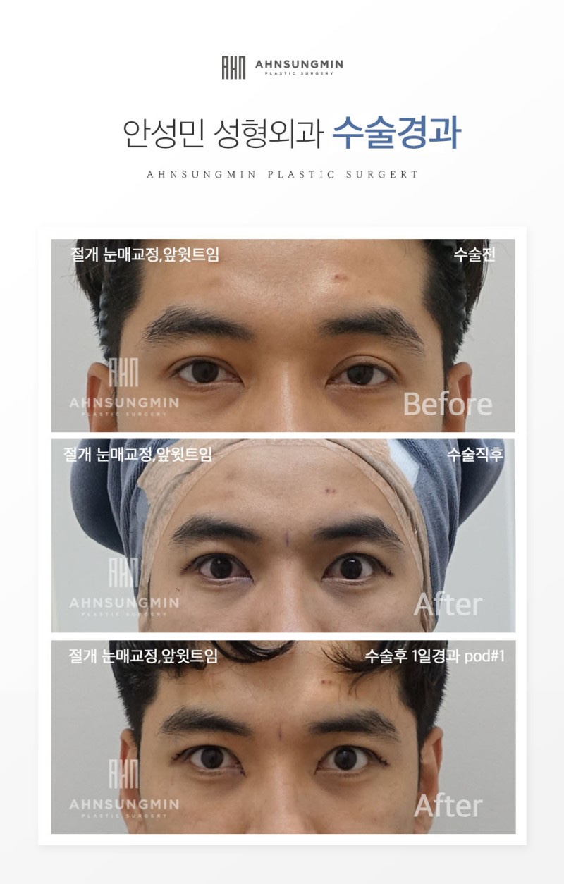 눈붓기빨리빼는법 체크해 보세요! 관련 이미지 8