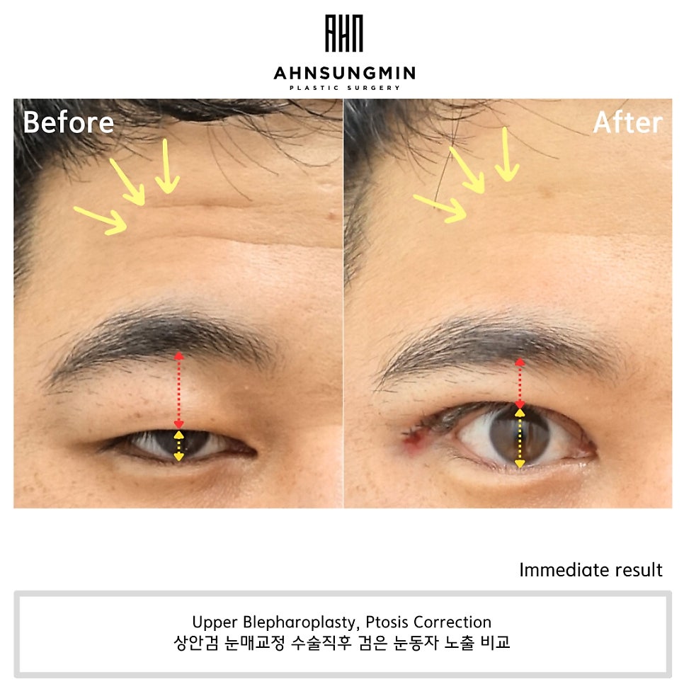 30대 남자 눈매교정 수술 직후 관련 이미지 2
