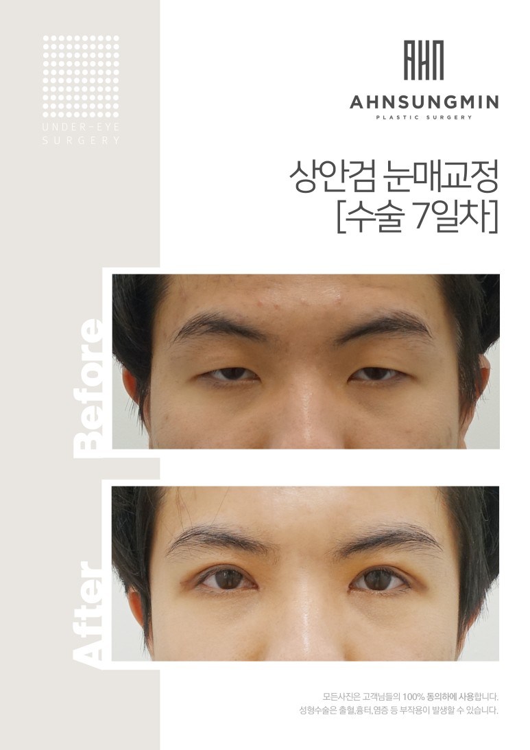 상안검 눈매교정 관련 이미지 2