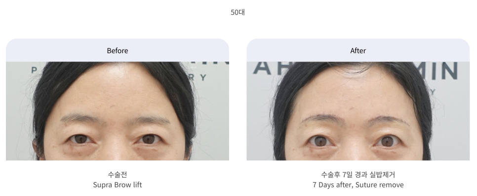 눈썹거상 수술의 장점과 나이대별 회복 과정 관련 이미지 4